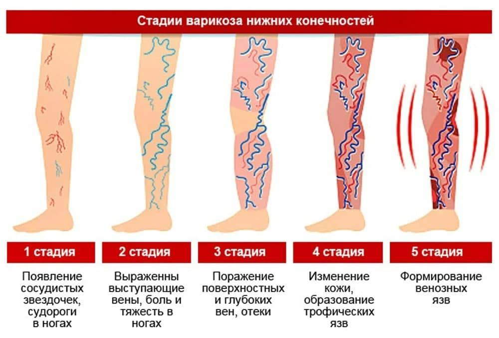 Варикозное расширение вен