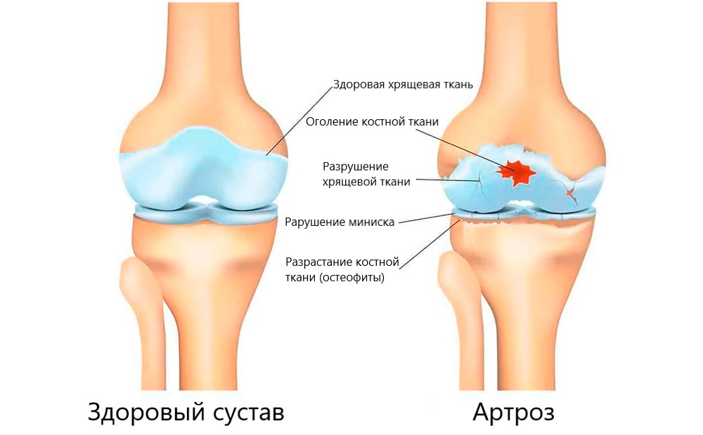 Что такое Артроз?