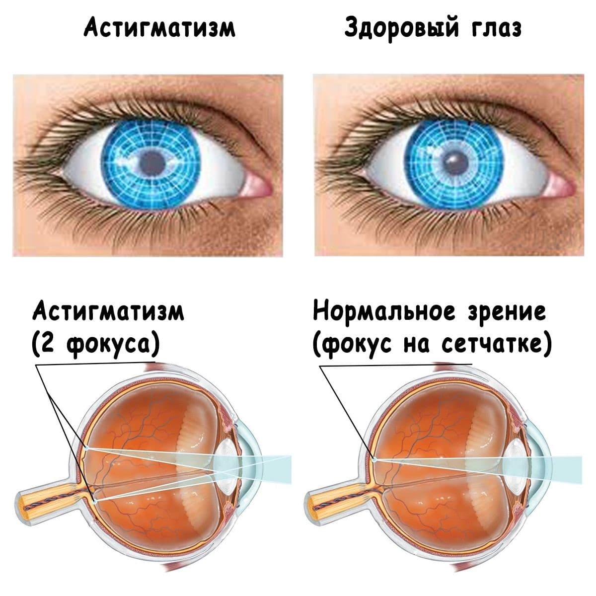 Что такое Астигматизм?