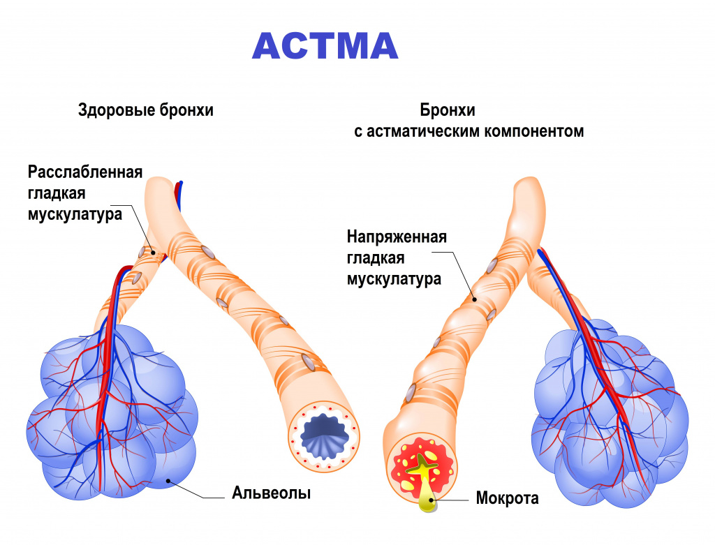 Бронхиальная астма