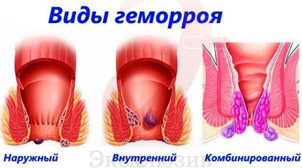 Геморрой