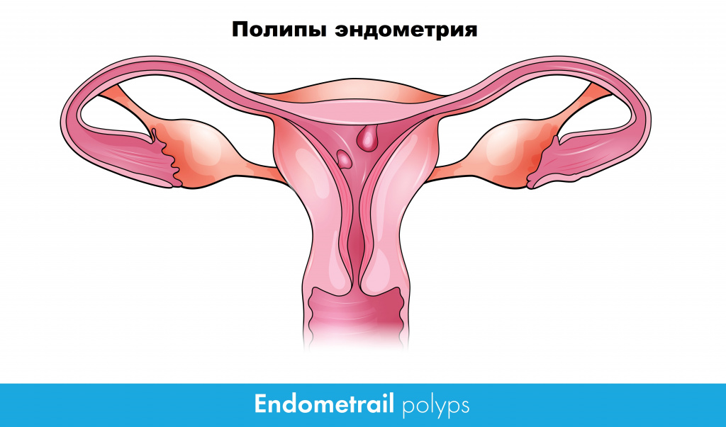 Гиперплазия