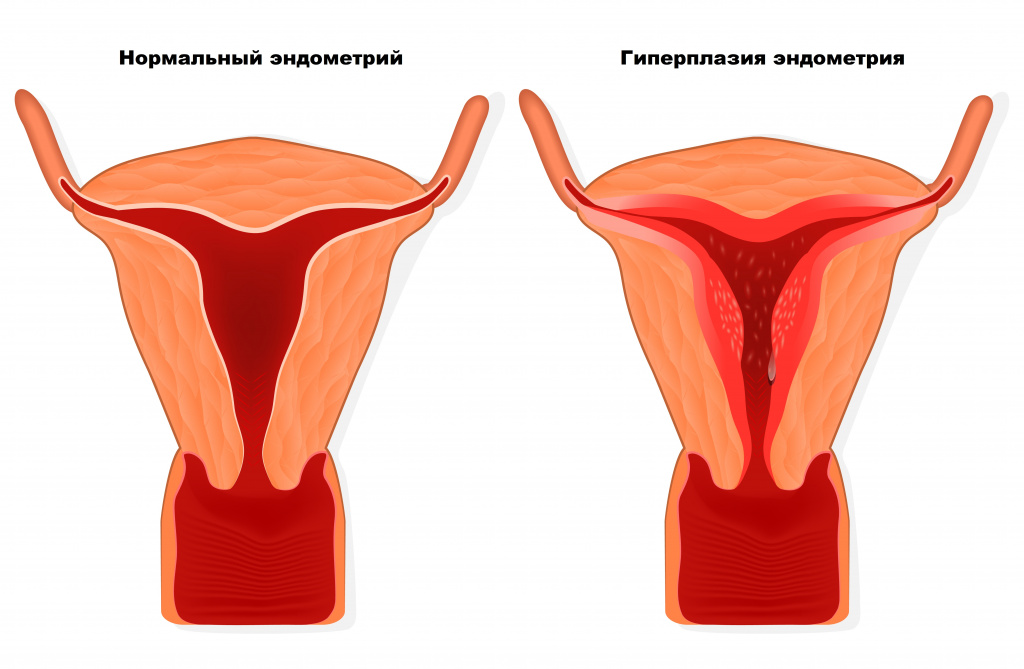 Гиперплазия