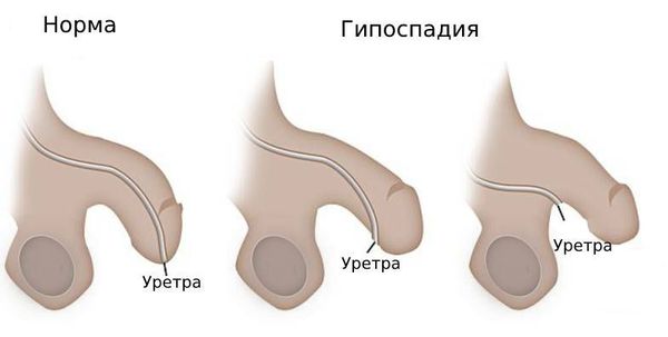 Гипоспадия